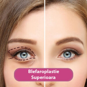 Blefaroplastie Superioara