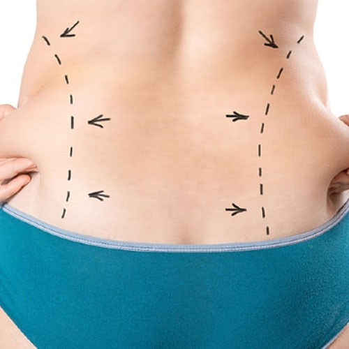 Liposuctie asistata cu aspiratie
