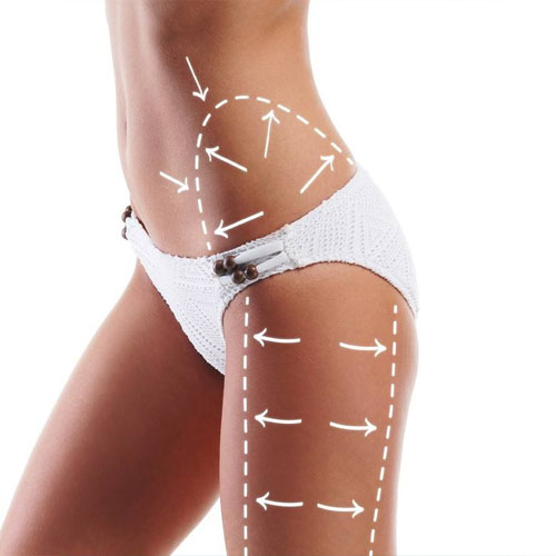 Liposuctie asistata cu ultrasunete