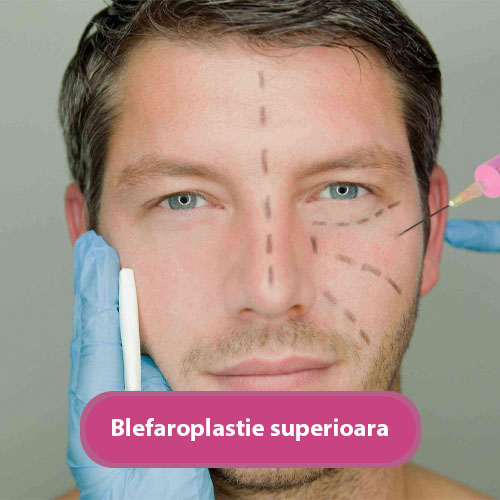 blefaroplastie