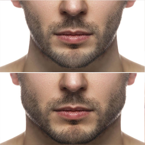 filler jawline