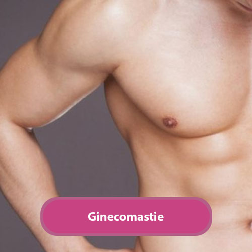 ginecomastie
