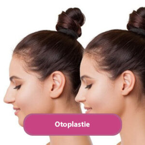 otoplastie