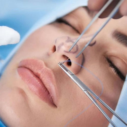 rinoplastia