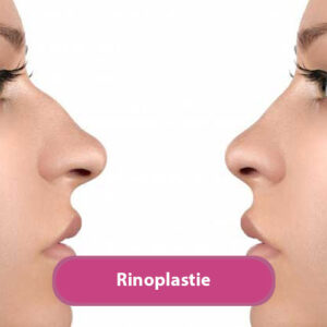 rinoplastie